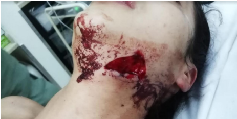 Orificio de entrada de proyectil de arma de fuego en regi&oacute;n cervical izquierda, con bordes asim&eacute;tricos y avulsi&oacute;n de tejidos.