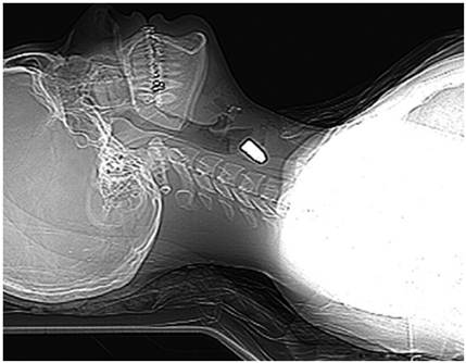 Proyecci&oacute;n radiogr&aacute;fica lateral en dec&uacute;bito supino, visualizando el proyectil de arma de fuego en el cuello, a nivel del quinto cuerpo vertebral (C5), con trayecto oblicuo y descendente en direcci&oacute;n al t&oacute;rax y localizado en los tejidos blandos.