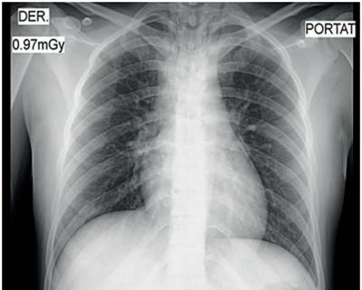 Radiograf&iacute;a anteroposterior de t&oacute;rax observando una adecuada expansi&oacute;n pulmonar, sin encontrar hemot&oacute;rax o neumot&oacute;rax y sin derrame pleural.