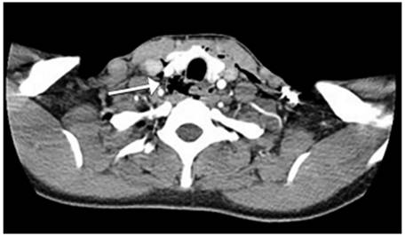 Se observa enfisema subcut&aacute;neo con soluci&oacute;n de continuidad en los tejidos blandos de la regi&oacute;n cervical (flecha).