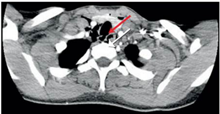 Se observa lesi&oacute;n de la tr&aacute;quea en el tercio medio que compromete su pared lateral derecha con soluci&oacute;n de continuidad y enfisema subcut&aacute;neo (flecha).
