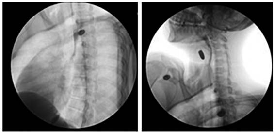 Esofagograma con contraste oral hidrosoluble, observando un trayecto y calibre normal, sin extravasaci&oacute;n del medio de contraste o presencia de trayectos fistulosos.
