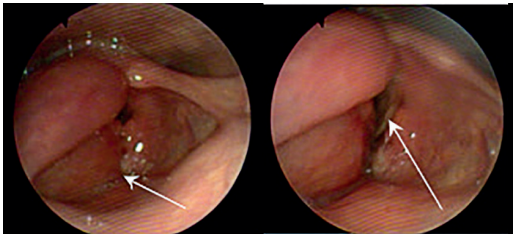 Nasofibrolaringoscopia observando un hematoma en la hemi-laringe derecha (flecha corta) que obstru&iacute;a el 50 % de la luz gl&oacute;tica (flecha larga) impidiendo avanzar el naso-fibro-laringoscopio.