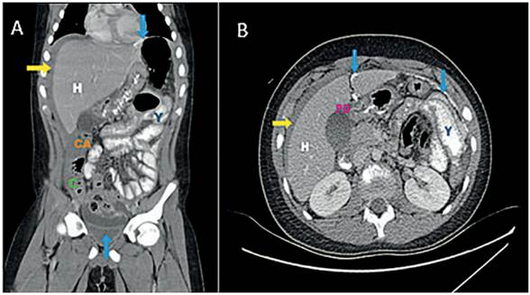 Tomografía computarizada abdominal contrastada (A: Corte sagital, B: corte axial). Perforación duodenal (PD) y extravasación del medio de contraste oral (flecha azul), abundante líquido libre (flecha amarilla). Se observa hepatomegalia (H) y engrosamiento del yeyuno (Y), ciego (C) y colon ascendente (CA).