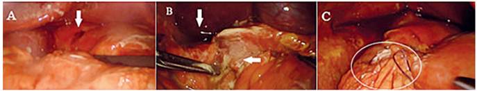 A: sitio de perforación duodenal en la primera porción (flecha). B: líquido libre en cavidad (flecha vertical) y membranas fibrinopurulentas (flecha horizontal). C: reparación laparoscópica concluida, se ha sellado la perforación con parche de Graham (círculo).