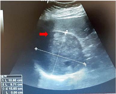 Ultrasonografía con evidencia de lesión tumoral en glándula suprarrenal derecha.
