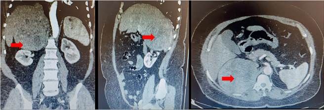Tomografía computarizada de abdomen simple y contrastada con evidencia de lesión tumoral en la glándula suprarrenal derecha.