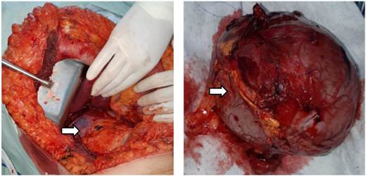 A. Hallazgo quirúrgico. B. Aspecto macroscópico del tumor resecado.