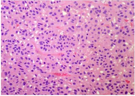 Histológicamente las células neoplásicas tienen citoplasma amplio, eosinofílico, con núcleos ovoides centrales, leve pleomorfismo y se disponen en nidos, dando un aspecto descrito como “organoide” (hematoxilina-eosina, 400X).