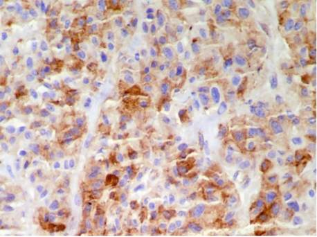 La inmunohistoquímica demostró positividad para sinaptofisina, con negatividad para citoqueratinas e inhibina, lo cual ayudó a confirmar el diagnóstico de feocromocitoma (inmunohistoquímica para sinaptofisina, 400X).