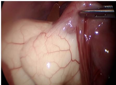 Identificaci&oacute;n laparosc&oacute;pica de malformaci&oacute;n linf&aacute;tica abdominal. Lesi&oacute;n en meso de yeyuno proximal.