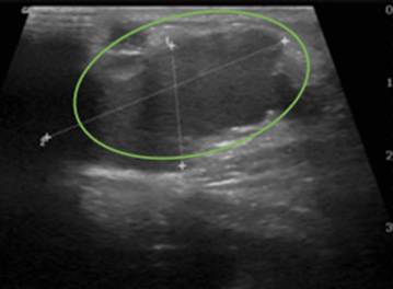 En la ecograf&iacute;a se observa una estructura cil&iacute;ndrica dilatada y anecoica que se contin&uacute;an con una de mayor de tama&ntilde;o, de contornos lobulados, bien definida e hipoecoica, con septos en su interior 3,5 x 1,6 cm. No se identifica componente s&oacute;lido o calcificaciones y no presenta flujo al aplicar el Doppler color.