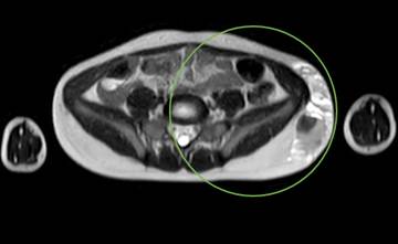 En la resonancia nuclear magn&eacute;tica se observa una masa que deforma la pared lateral del flanco y el lado izquierdo de la pelvis, de 4 x 9 x 2,8 cm, con niveles l&iacute;quido-l&iacute;quido (por sangrado) y septos internos demostrando hematoma en diferentes fases.