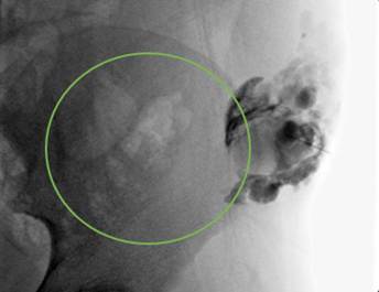 Flebograma que identifica una masa multiqu&iacute;stica y multiseptada, con cavidades de tama&ntilde;o variable, sin comunicaci&oacute;n con estructuras vasculares. Se verifica posici&oacute;n de la lesi&oacute;n y se aspira, para posteriormente inyectar bleomicina.