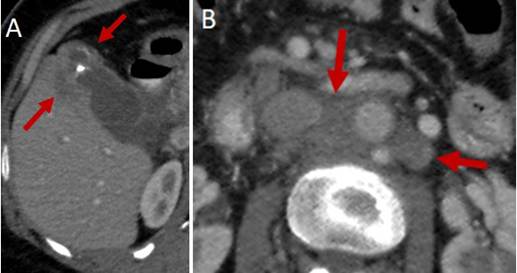 Tomograf&iacute;a axial que muestra masa en el fondo de la ves&iacute;cula (A) y compromiso ganglionar para a&oacute;rtico (B).