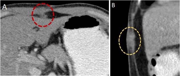 Tomograf&iacute;a axial que muestra siembras tumorales en la pared abdominal y en el trayecto de los puertos, en paciente con antecedente de colecistectom&iacute;a v&iacute;a laparosc&oacute;pica y hallazgo de CIVB. Siembra en el ligamento redondo, corte axial (A). Siembra en los m&uacute;sculos de pared abdominal, corte sagital (B).
