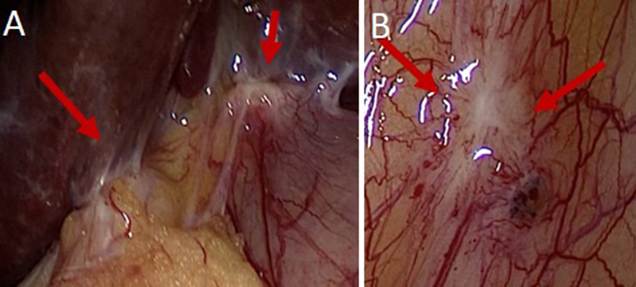 Hallazgos laparosc&oacute;picos de compromiso peritoneal por c&aacute;ncer de ves&iacute;cula, dos meses despu&eacute;s de colecistectom&iacute;a v&iacute;a laparosc&oacute;pica por colelitiasis, con hallazgo inicial de CIVB. Siembras en el lecho quir&uacute;rgico (A) y siembra en el peritoneo parietal (B).