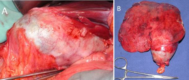 Carcinoma de ves&iacute;cula biliar (A). Pieza quir&uacute;rgica incluyendo la ves&iacute;cula y los segmentos 4b y 5 (B).