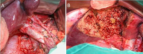 Resecci&oacute;n radical por c&aacute;ncer de ves&iacute;cula biliar. Linfadenectom&iacute;a hiliar (A) y resecci&oacute;n hep&aacute;tica de los segmentos 4b y 5 (B).