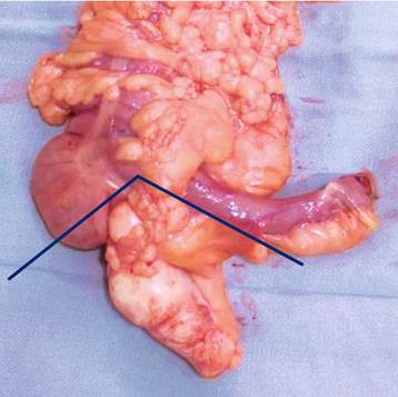Apendicectom&iacute;a radical. Incluye base apendicular libre (cequectom&iacute;a si es necesario), mesenterio apendicular desde la emergencia de arteria apendicular y el borde antimesent&eacute;rico del ligamento de Tr&eacute;ves.