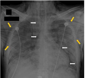 Radiograf&iacute;a de t&oacute;rax en la que se observa el gran enfisema subcut&aacute;neo (flechas amarillas) y el neumomediastino (flechas blancas).