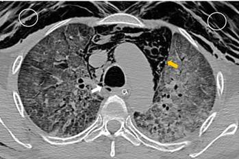 Tomograf&iacute;a computarizada de t&oacute;rax (ventana pulmonar). Se muestra el enfisema subcut&aacute;neo (c&iacute;rculos blancos) y el neumomediastino masivo (flecha amarilla). La flecha blanca se&ntilde;ala la perforaci&oacute;n en la tr&aacute;quea distal.