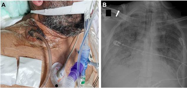 A. Fotograf&iacute;a del paciente con el sistema de presi&oacute;n negativa en la regi&oacute;n supraclavicular derecha. B. Radiograf&iacute;a de t&oacute;rax despu&eacute;s de tres d&iacute;as de tratamiento con resoluci&oacute;n total del enfisema subcut&aacute;neo y en gran medida del neumomediastino. La flecha se&ntilde;ala el dispositivo de terapia de presi&oacute;n negativa &ldquo;in situ&rdquo;.