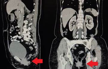 Tomograf&iacute;a computarizada en la que se observa la hernia se&ntilde;alada por la flecha roja en los cortes sagital y coronal.