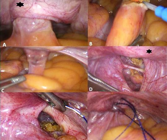 Reparo laparosc&oacute;pico de la hernia perineal. * Vejiga. A. Visualizaci&oacute;n de la hernia perineal adherida. B. Liberaci&oacute;n de contenido de la hernia perineal de la pared abdominal. C. Visualizaci&oacute;n del ap&eacute;ndice epipl&oacute;ico contenido. D. Orificio herniario. E. Inicio del cierre de defecto con sutura barbada. F. Defecto herniario cerrado.