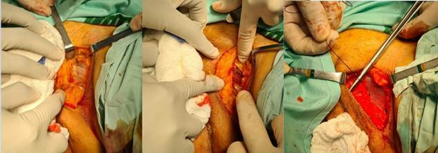 Reparo del defecto herniario con malla por un abordaje externo.