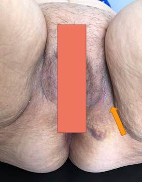 Imagen posoperatoria un mes despu&eacute;s de la cirug&iacute;a. Se observa la cicatriz del procedimiento (Flecha amarilla).