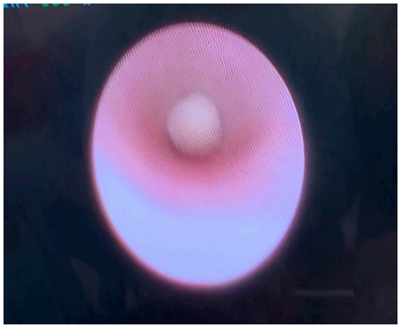 Calculo flotante tratado con sialoendoscopia.