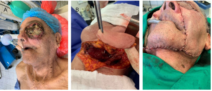 Reconstrucci&oacute;n en paciente con lesi&oacute;n en la cavidad orbitaria. A) Evaluaci&oacute;n intraoperatoria de la lesi&oacute;n. B) Reconstrucci&oacute;n con colgajo submentoniano. C) Valoraci&oacute;n en el postoperatorio inmediato.