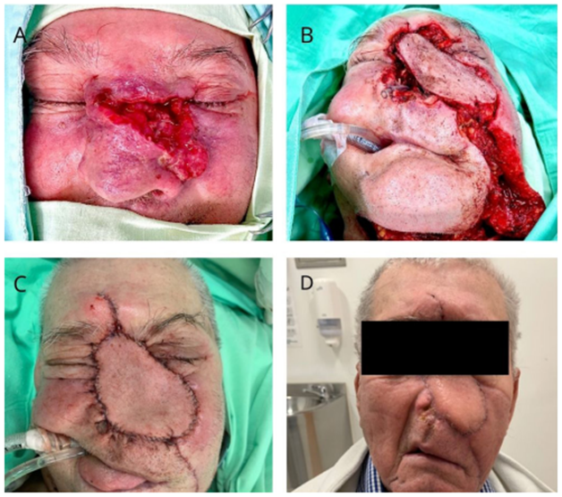 T&eacute;cnica quir&uacute;rgica CTAS est&aacute;ndar. A) Evaluaci&oacute;n intraoperatoria de la lesi&oacute;n en piel del dorso y puente nasal. B) Reconstrucci&oacute;n de defectos con la t&eacute;cnica CTAS est&aacute;ndar. C) Valoraci&oacute;n en el post operatorio inmediato. D) Evaluaci&oacute;n en el postoperatorio tard&iacute;o.