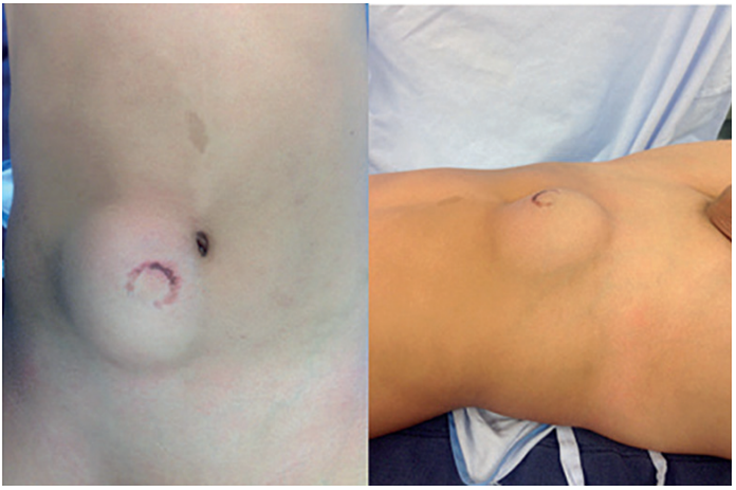 Trauma cerrado de abdomen en un paciente pedi&aacute;trico con tatuaje del manubrio de la bicicleta y evidencia cl&iacute;nica de hernia traum&aacute;tica.