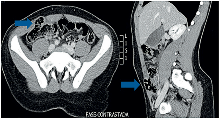 Tomograf&iacute;a abdominal en corte axial (A) y sagital (B) que diagnostica la hernia traum&aacute;tica de la pared abdominal. Las flechas indican el punto del defecto de la pared abdominal con herniaci&oacute;n visceral.