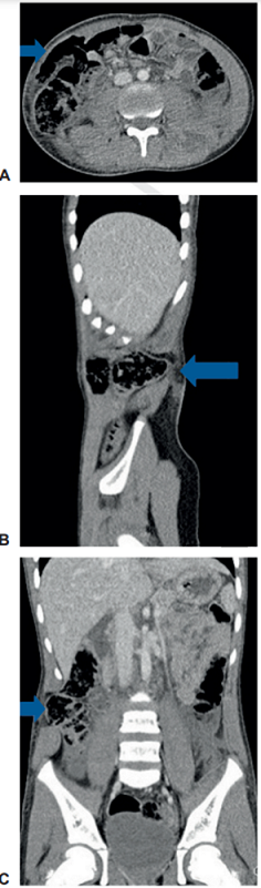Tomograf&iacute;a de abdominal que muestra las hernias traum&aacute;ticas de la pared abdominal. A, corte axial, B, sagital y C, coronal. Las flechas indican la localizaci&oacute;n de la hernia traum&aacute;tica.