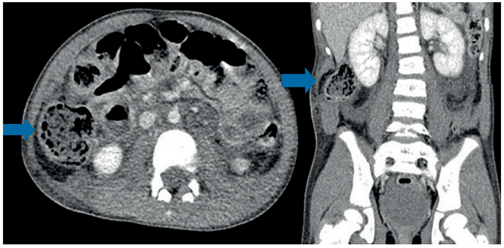 Hernias traum&aacute;ticas de la pared abdominal en corte axial y corte coronal. Note la herniaci&oacute;n visceral en el flanco derecho. Las flechas muestran la hernia traum&aacute;tica.