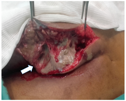 Femenina adulta joven, diabética, con proceso inflamatorio, necrótico y enfisematoso del glúteo izquierdo. La flecha blanca señala el tejido con necrosis.