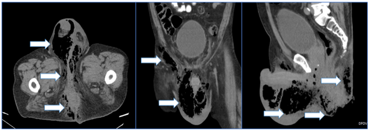 Tomografía computarizada que muestra el proceso inflamatorio enfisematoso que afecta la región perianal, genital, glútea e inguinal derecha. Se observa proceso enfisematoso a nivel de la grasa peri-rectal. Las flechas blancas señalan las áreas de enfisema.