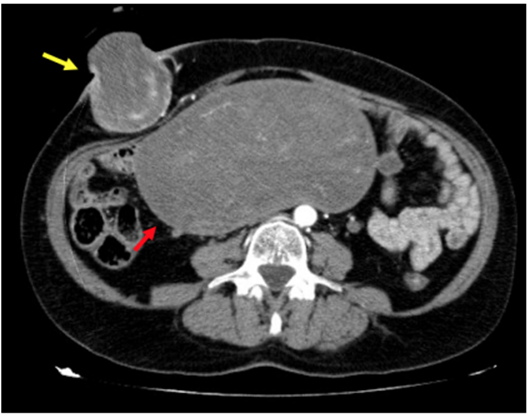 Tomograf&iacute;a computarizada abdominal que muestra tumoraci&oacute;n uterina (flecha roja) y met&aacute;stasis parietal (flecha amarilla).