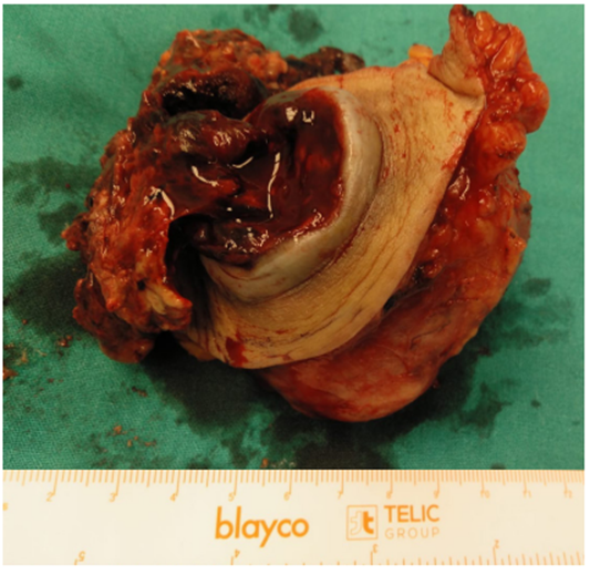 Ex&eacute;resis en bloque de lesi&oacute;n localizada en tejido celular subcut&aacute;neo que correspondi&oacute; a met&aacute;stasis parietal de sarcoma uterino.