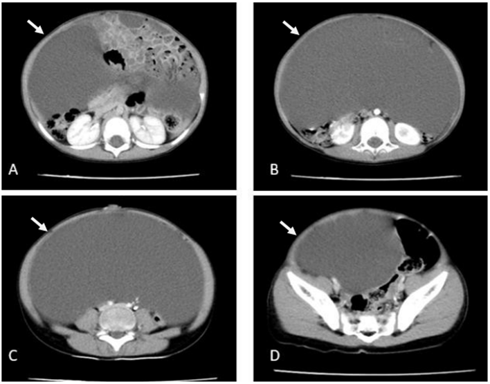 Tomograf&iacute;a computarizada de abdomen contrastada. Se observa lesi&oacute;n qu&iacute;stica gigante con desplazamiento de asas intestinales. Las flechas se&ntilde;alan la lesi&oacute;n. 