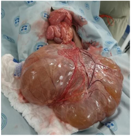 Lesi&oacute;n qu&iacute;stica multilobulada y pediculada de 24 x 20 x 12 cm dependiente del meso del &iacute;leon. N&oacute;tese la relaci&oacute;n respecto al abdomen de la paciente.