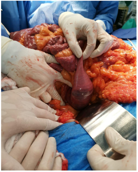 C&aacute;lculo de 10 x 5 cm en el duodeno, el cual se avanza manualmente hasta la primera asa de yeyuno.