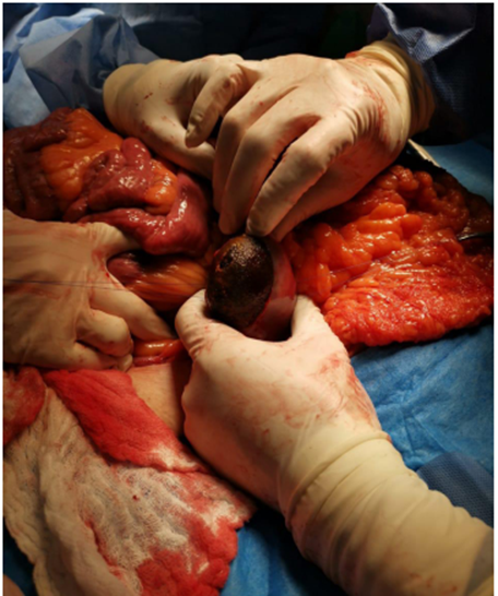 Enterotom&iacute;a longitudinal para la extracci&oacute;n del c&aacute;lculo.