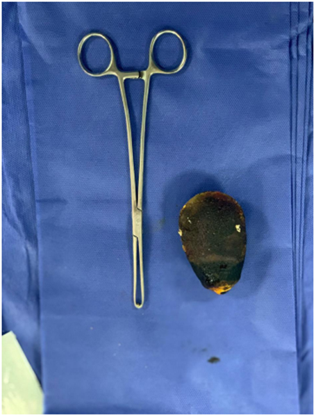 C&aacute;lculo biliar extra&iacute;do.