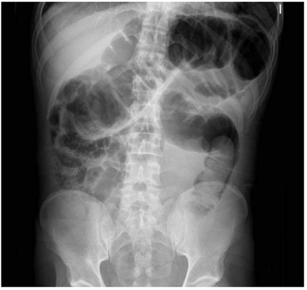 Radiograf&iacute;a simple de abdomen donde se aprecia la marcada dilataci&oacute;n del colon.