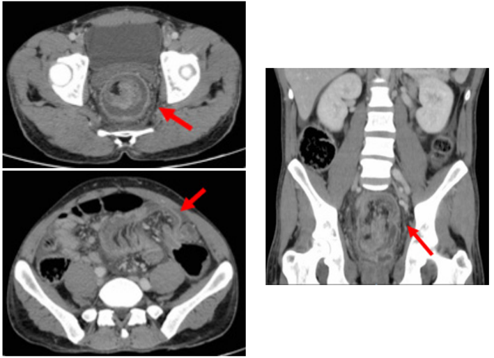 Tomograf&iacute;a computarizada abdominop&eacute;lvica, con 2 secciones axiales y 1 secci&oacute;n coronal. La &ldquo;imagen en diana&rdquo; se&ntilde;alada por la flecha roja representa la invaginaci&oacute;n col&oacute;nica.