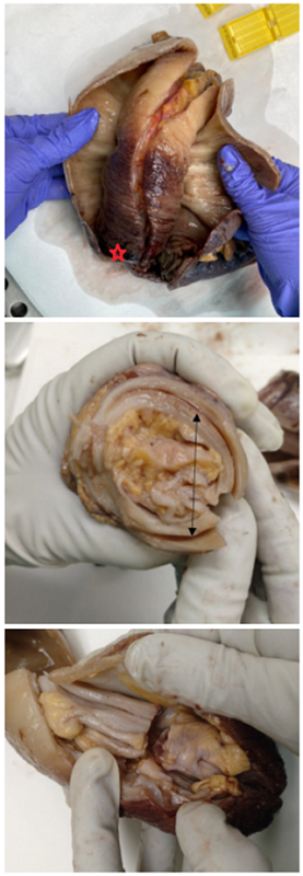 Pieza quir&uacute;rgica donde se aprecia el adenoma tubular (*) en el intussusceptum (flecha negra).